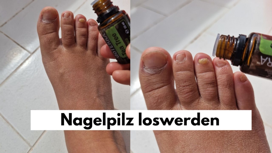 Nagelpilz mit ätherischen Ölen loswerden